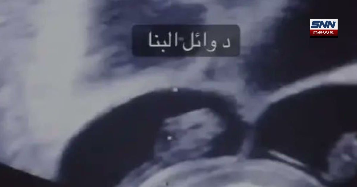 Egyptian woman discovers she is pregnant with nine babies
